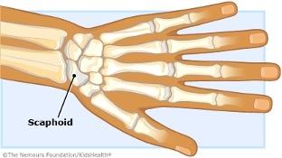 Scaphoid Fracture