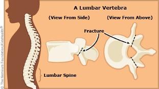 Spondylolysis