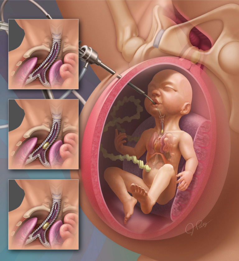 CDH FETO Surgical Repair
