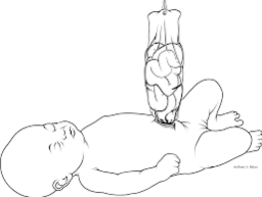 Gastroschisis Silo