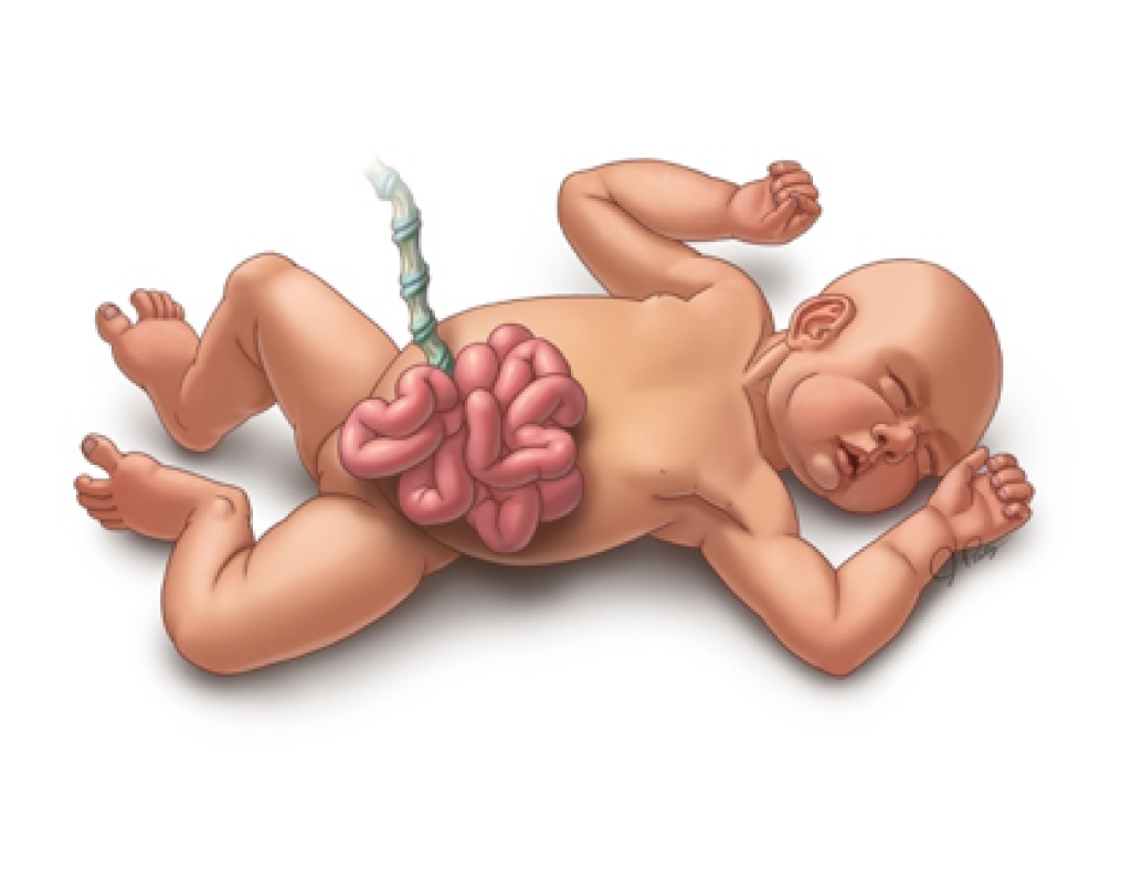 Gastroschisis