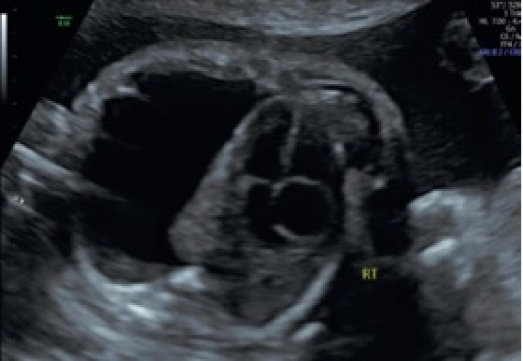 Pleural Effusion