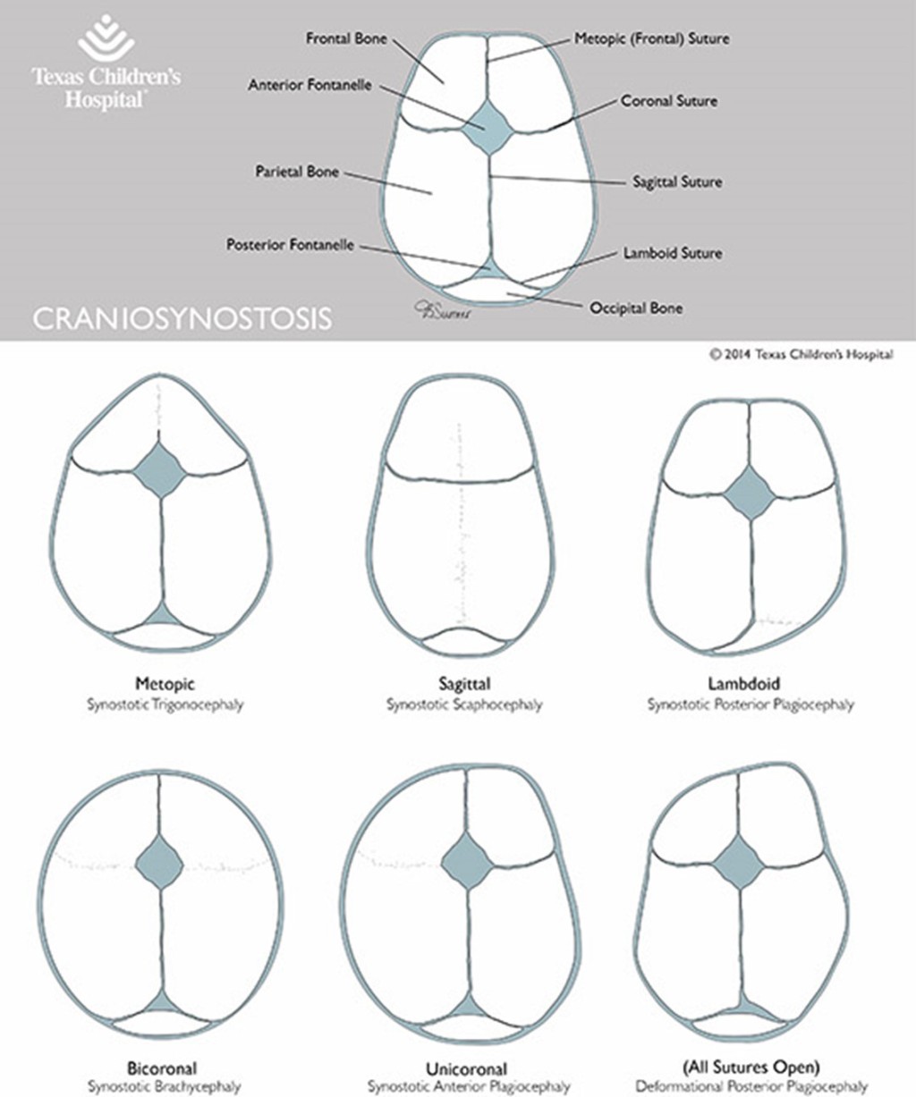 Craniosynostosis