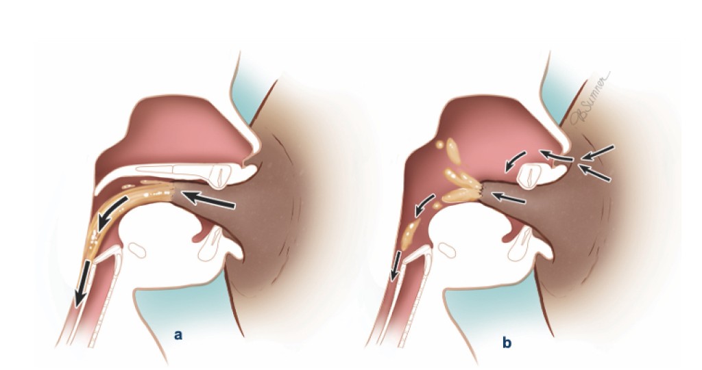 Cleft and breastfeeding