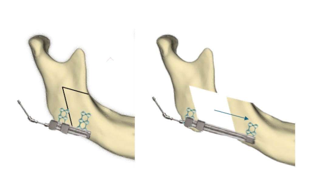 mandibular distraction