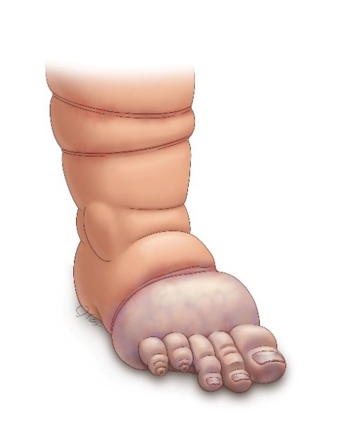 Amniotic Band Resection